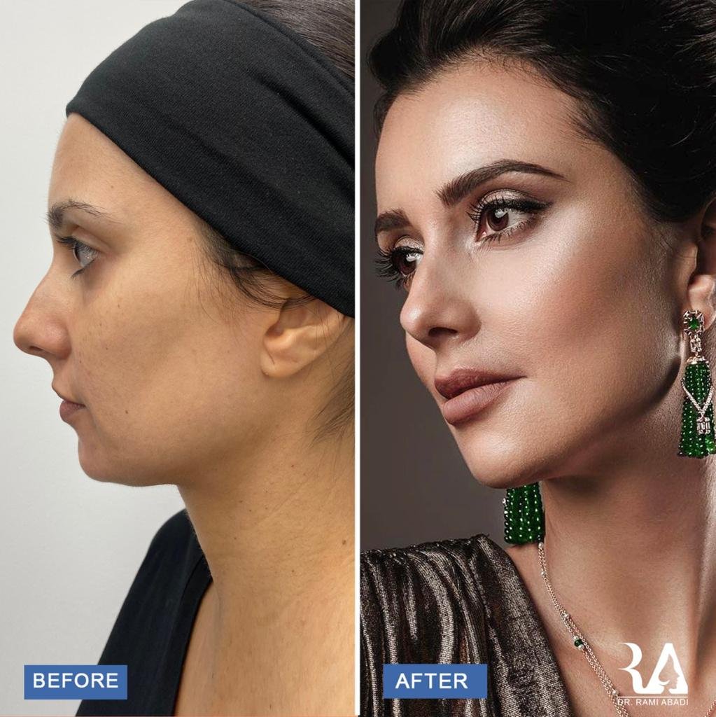 Filler Injections: Types, Uses and Risks... Tips about the Procedure with Dr. Rami Abadi 1 16501461497c12f3ad03